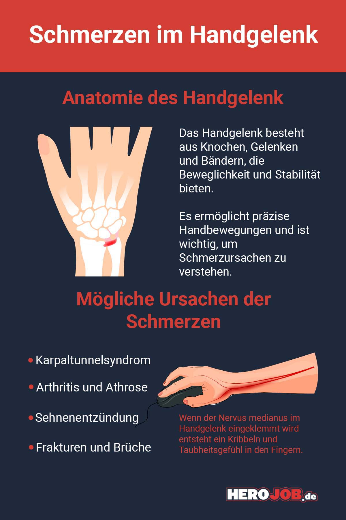 Anatomie des Handgelenk Das Handgelenk besteht aus Knochen, Gelenken und Bändern, die Beweglichkeit und Stabilität bieten. Es ermöglicht präzise Handbewegungen und ist wichtig, um Schmerzursachen zu verstehen. Mögliche Ursachen der Schmerzen * Karpaltunnelsyndrom * ﻿﻿Arthritis und Athrose * ﻿﻿Sehnenentzündung * ﻿﻿Frakturen und Brüche Wenn der Nervus medianus im Handgelenk eingeklemmt wird entsteht ein Kribbeln und Taubheitsgefühl in den Fingern.